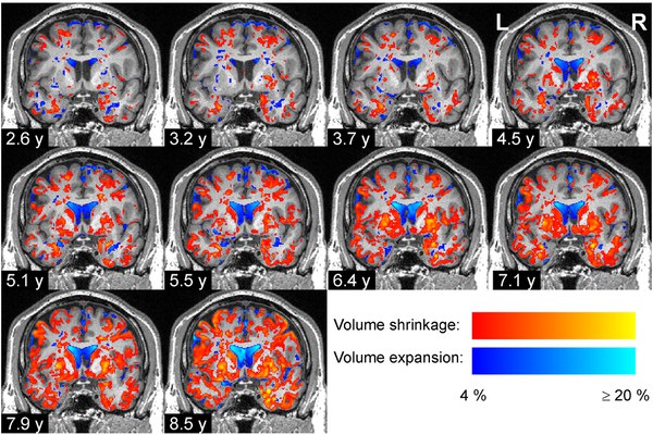 Neue Studie zeigt, wie sich die Volumina von Hirnregionen bei der Parkinson-Krankheit verändern
