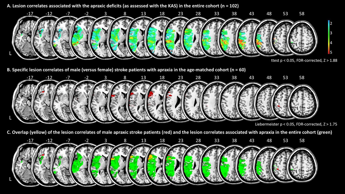 Differential lesion patterns associated with stroke-induced apraxia in women and men