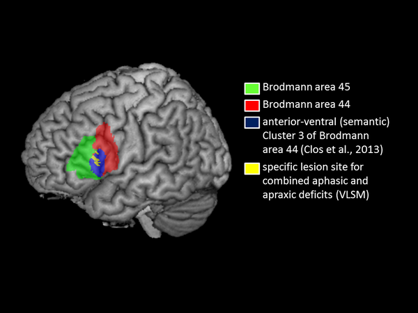 Cognitive deficits after stroke